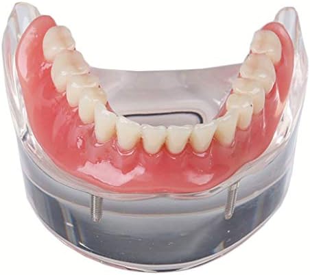 Model lemita zubnog implantata - model zubnih zuba Transparentni model implantacije s 2 nokta - za model podučavanja zuba,